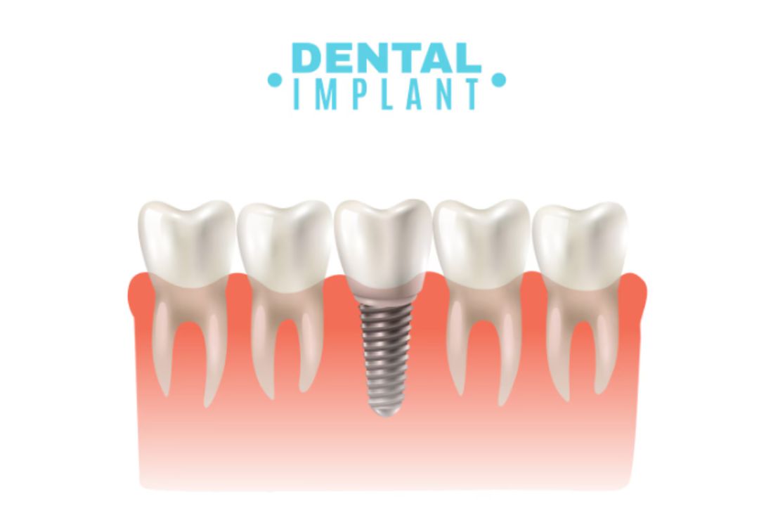 new dental implant cost per tooth india breakdown